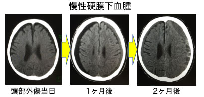 慢性硬膜下血腫