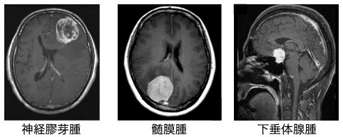 脳腫瘍について
